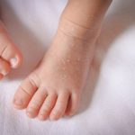 Dampak Jika Kulit Kering Anak Dibiarkan Begitu Saja